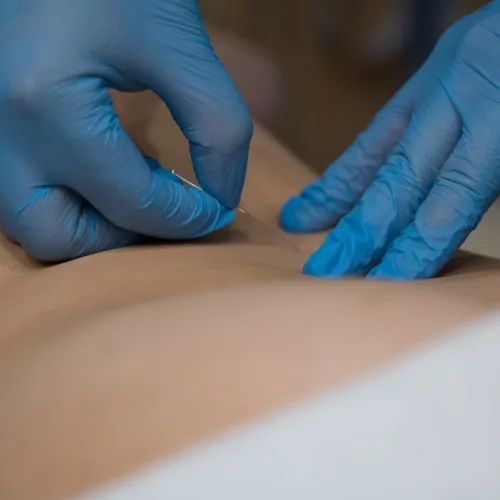 dry-needling-carolina-prime-physical-therapy-north-wilkerson-nc